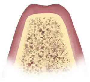 dental implants Midlothian Virginia