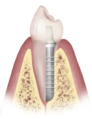 dental implants illustration Midlothian VA | Virginia Oral Surgeons | Commonwealth Oral & Facial Surgery