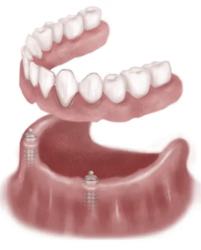 dental implants illustration Midlothian VA | Virginia Oral Surgeons | Commonwealth Oral & Facial Surgery