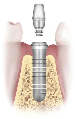 dental implants illustration Richmond VA | Virginia Oral Surgeons | Commonwealth Oral & Facial Surgery