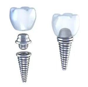 dental implants Richmond
