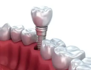 bone grafting Richmond