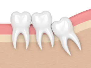 wisdom teeth Midlothian