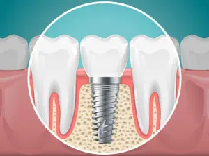 dental implants Richmond