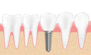 bone grafting Midlothian