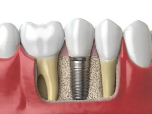 dental implants Richmond