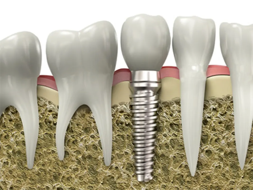 bone grafting Henrico