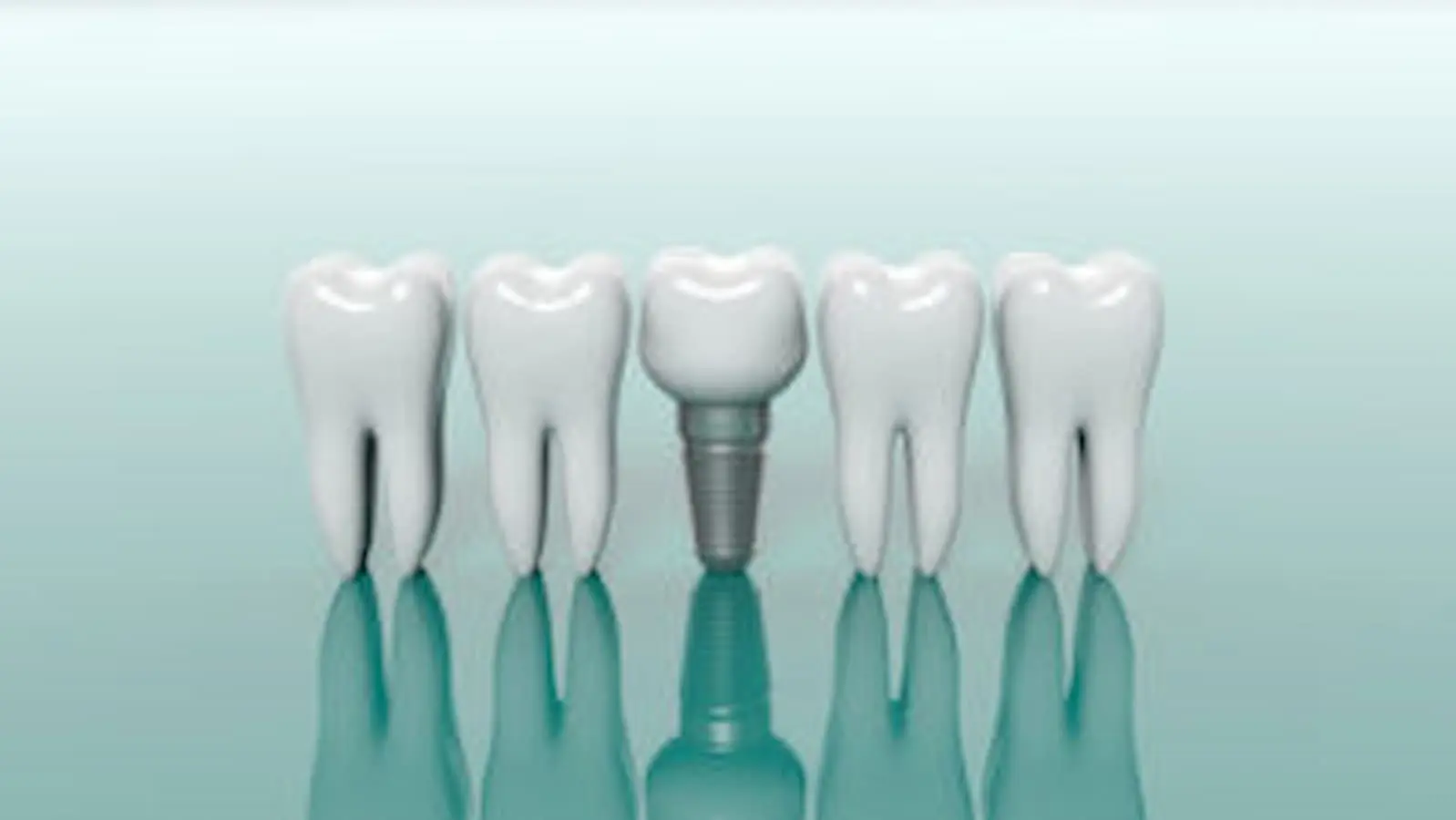 dental implants Henrico