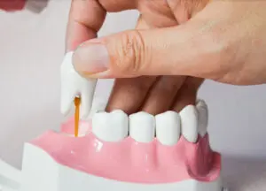 richmond wisdom tooth