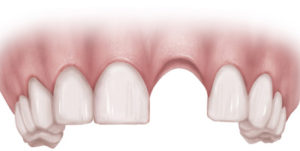 dental implant Henrico VA