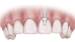 dental implant Richmond VA