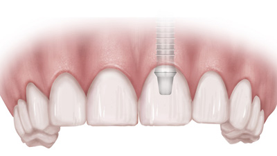dental implants illustration Richmond VA | Virginia Oral Surgeons | Commonwealth Oral & Facial Surgery