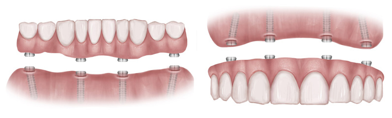dental-implants Richmond Virginia illust 12