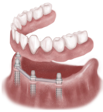 Dental implants illustration Richmond VA | Virginia Oral Surgeons | Commonwealth Oral & Facial Surgery
