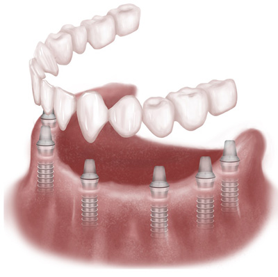 dental implants illustration Henrico VA | Virginia Oral Surgeons | Commonwealth Oral & Facial Surgery