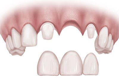 dental implants illustration Midlothian VA | Virginia Oral Surgeons | Commonwealth Oral & Facial Surgery