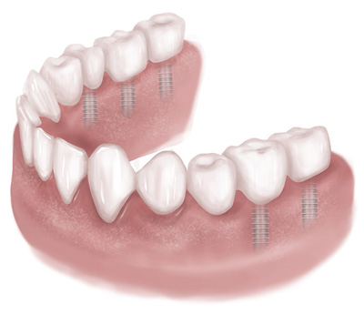 dental implants illustration Midlothian VA | Virginia Oral Surgeons | Commonwealth Oral & Facial Surgery