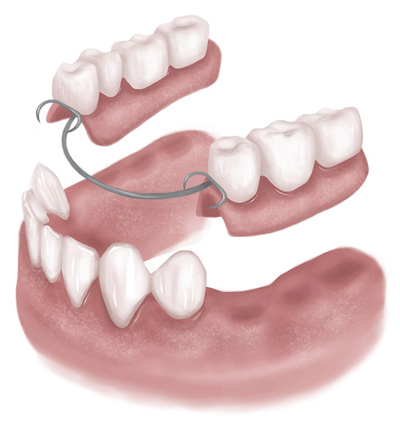 dental implants illustration Richmond VA | Virginia Oral Surgeons | Commonwealth Oral & Facial Surgery