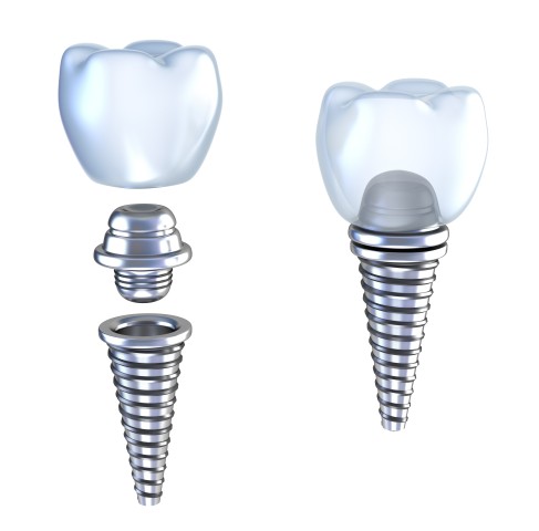 Structure of a Dental Implant | Commonwealth OFS