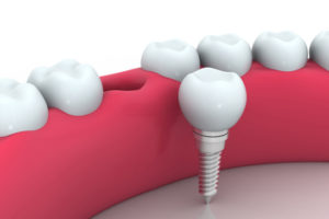 dental implants Midlothian