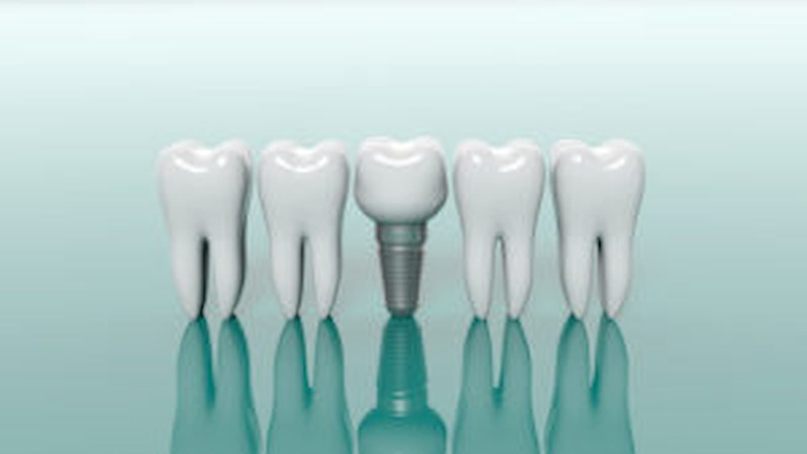 dental implants Henrico